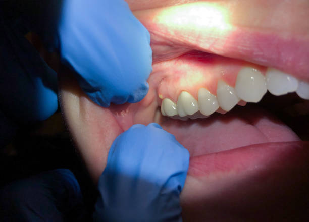 Best Emergency Dentist for Lost Fillings or Crowns in Happy Valley, OR